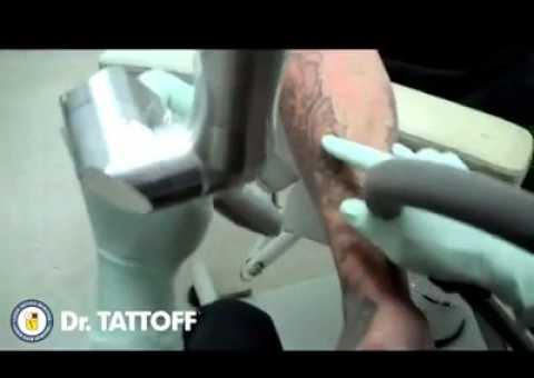 VÍDEO: Como remover sua tatuagem em poucos minutos
